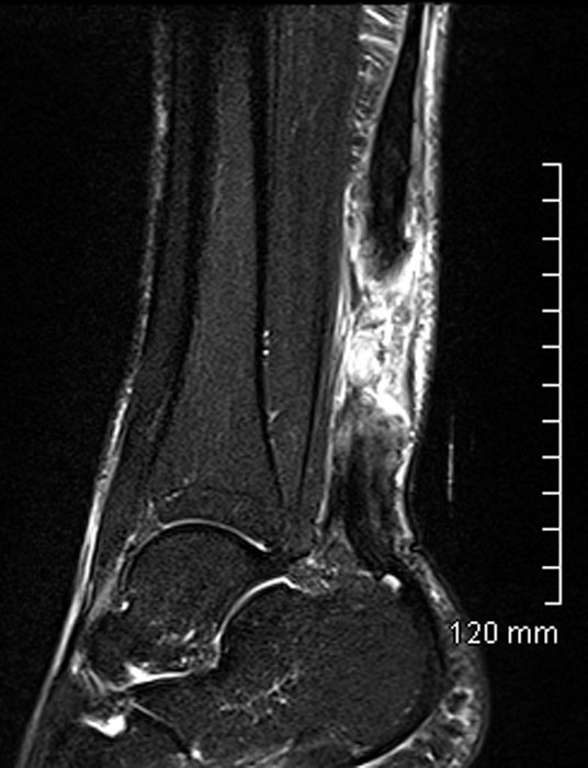 Imagerie Pathologie Arriere Pied Rupture Du Tendon Calcaneen